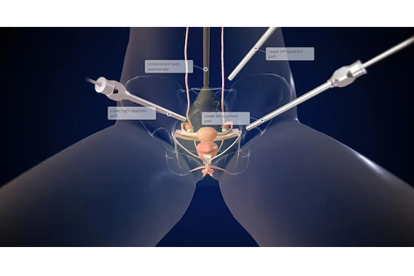 Hysterectomy