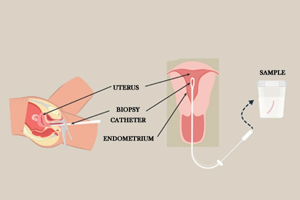 Endometrial Biopsy