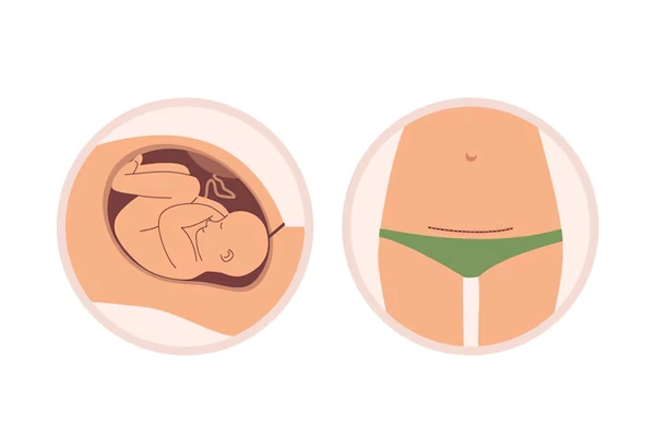 Caesarean Delivery